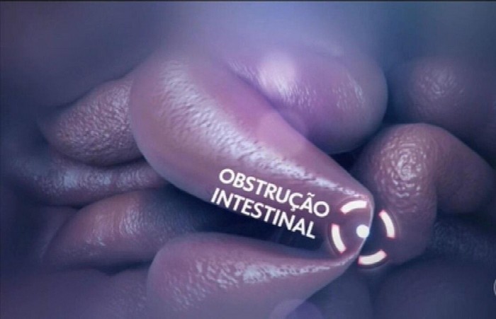 Obstrução intestinal: entenda o quadro de saúde de Jair Bolsonaro